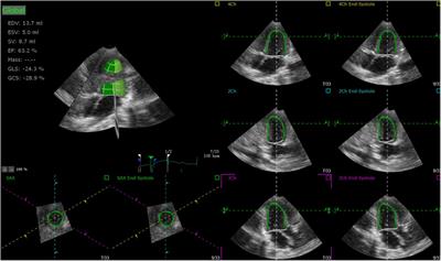 Comparison of cardiac function between single left ventricle and tricuspid atresia: assessment using echocardiography combined with computational fluid dynamics